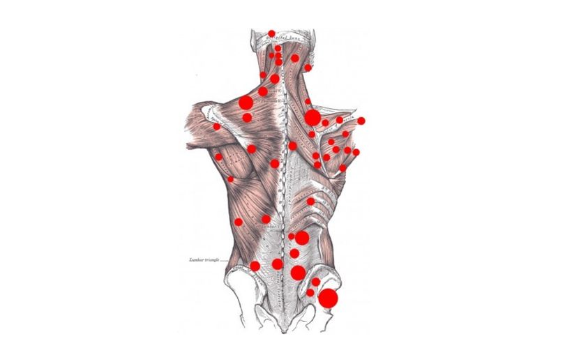 Myofasciální trigger pointy aneb spoušťové body