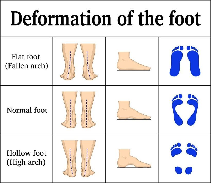 5 cvikov na ploché nohy: posilnite svoje chodidlá a zmiernite nepríjemné symptómy