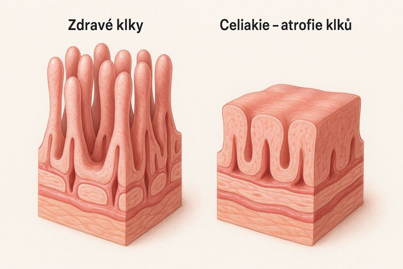 Alergie na lepek, nesnášenlivost lepku a celiakie - jak se liší?