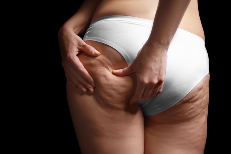 Ako sa zbaviť celulitídy? 7 tipov na boj s pomarančovou kožou