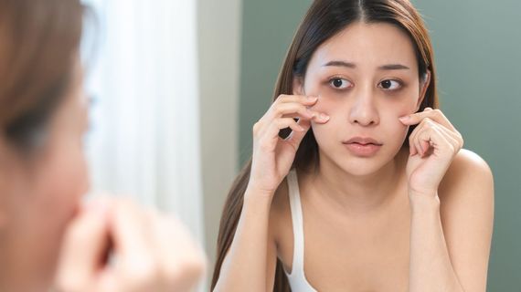 Trápia vás ráno opuchnuté oči? Vieme, čo pomôže