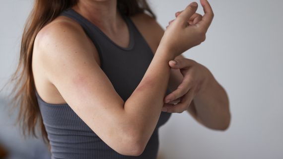 „Alergia“ na slnko: prečo vzniká a ako sa chrániť?