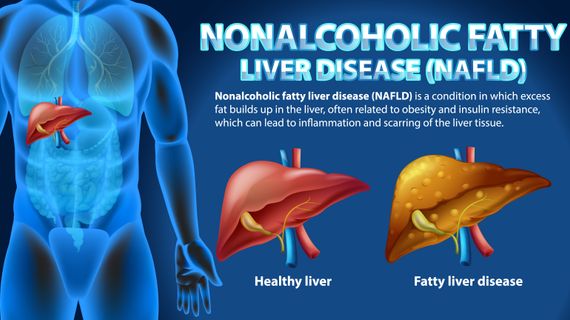 Steatóza jater pod kontrolou: Co jíst a čemu se vyhnout?