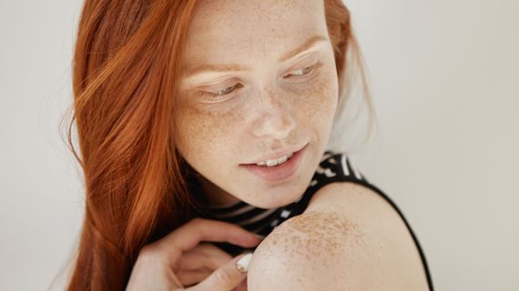 Co to je hyperpigmentace, jak na prevenci či léčbu?