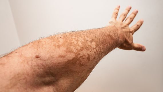 Pityriasis versicolor: časté ochorenie typické pre leto a mladých ľudí